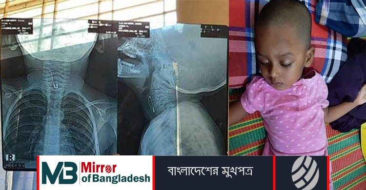 ৫২ ঘণ্টা পর শিশুর গলা থেকে বের হলো সেফটিপিন