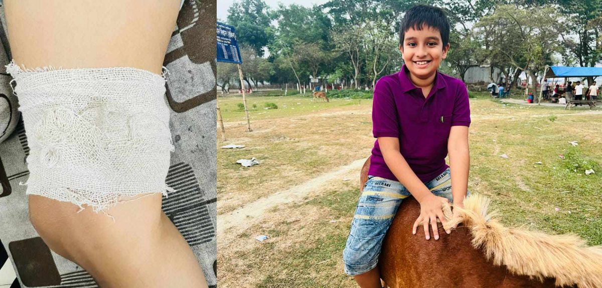 বেপরোয়া মোটরসাইকেলের ধাক্কা,শিক্ষকের সন্তানের পায়ে ৬ সেলাই