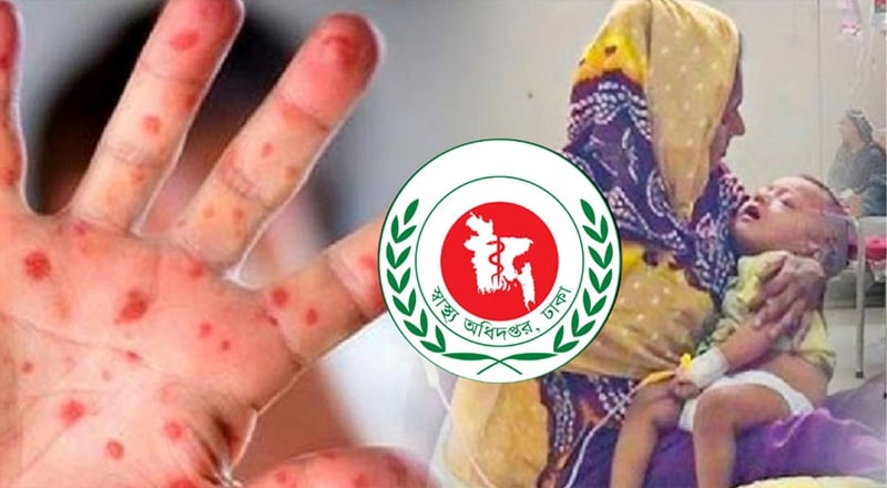 ২৪ ঘণ্টায় হাম উপসর্গে নিয়ে আরও ৪ শিশুর মৃত্যু
