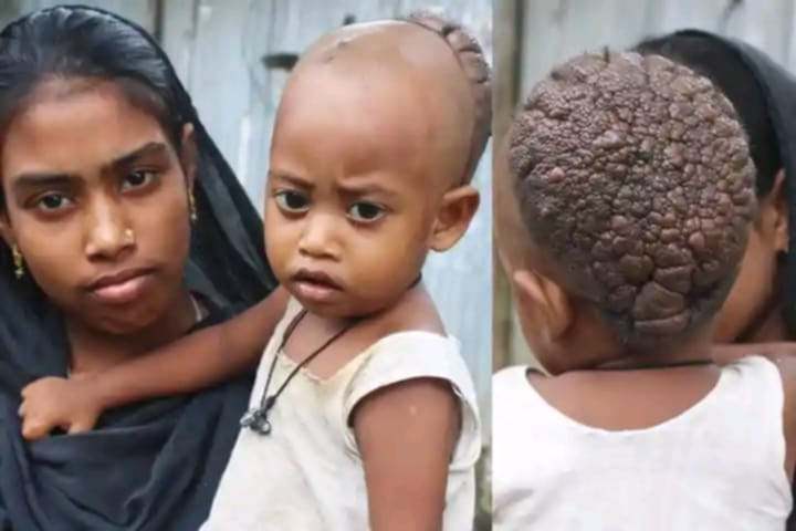 বিরল রোগে আক্রান্ত ছোট্ট শিশু সিফাত,চিন্তায় মা-বাবা